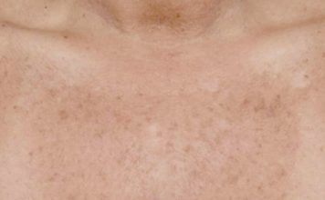 Macchie della pelle: quali sono i migliori rimedi per eliminarle